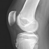 Sindrome di Osgood – Schlatter in un soggetto adulto. Trattamento con tecarterapia