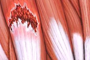 Lesioni muscolari, utile la diatermia