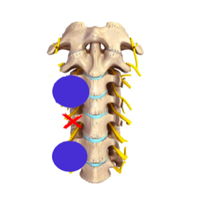 elettrodo bipolare trattamento faccetta articolare
