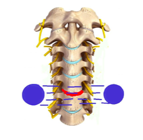 trattamento bipolare discale
