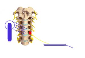 unipolare con piastra ed elettrodo